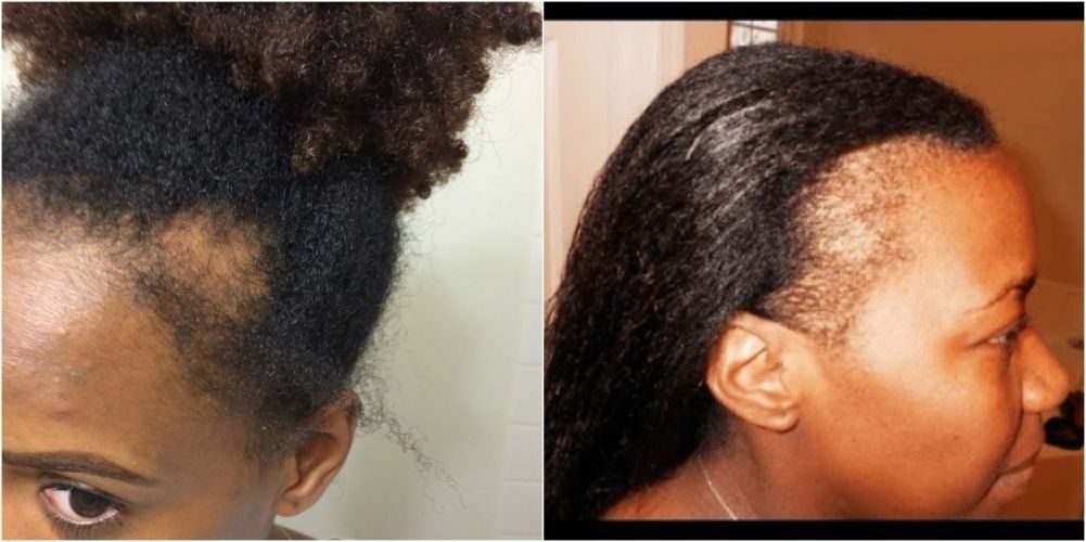 7 Ways To Keep Your Natural Hair Healthy While Wearing A Wig Within Most Recent Cornrows Hairstyles For Thin Edges (Photo 14 of 15)