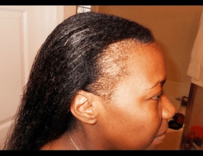 8 Steps How To Grow Your Edges Back In A Month In Best And Newest Braided Hairstyles Cover Bald Edges (View 7 of 15)
