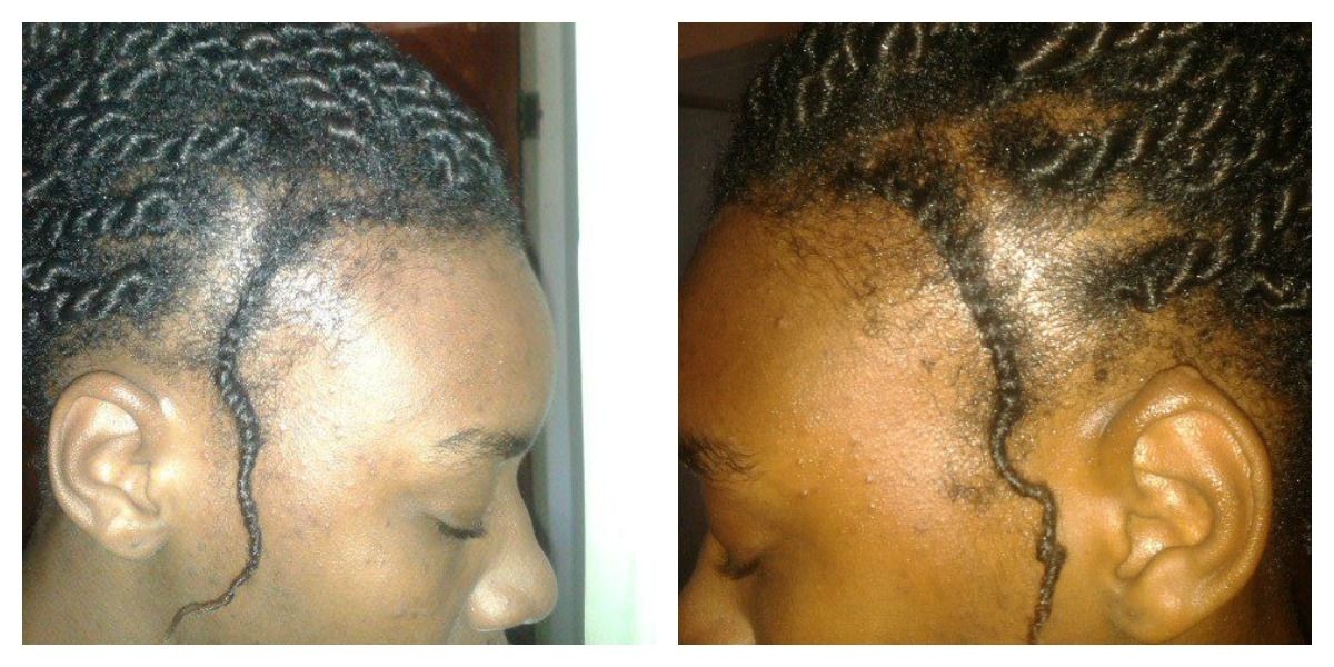 Regrow Your Edges – Naturally! – Black Zulu Pertaining To Current Cornrows Hairstyles For Weak Edges (View 13 of 15)