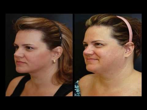 Simple Ways To Hide Double Chin With Makeup – Youtube Inside Long Hairstyles To Hide Double Chin (View 17 of 25)