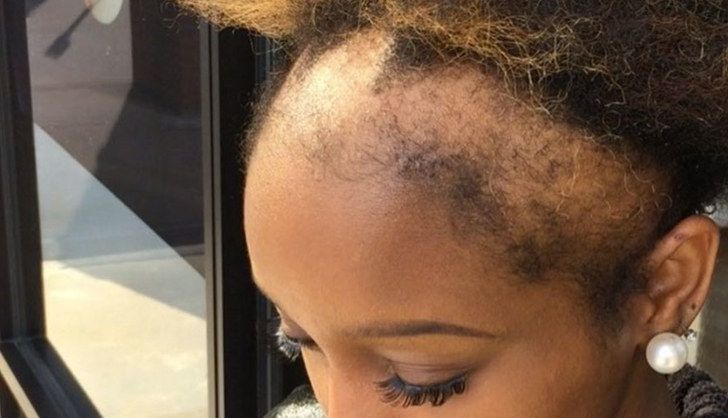This Woman's Honesty About Her Hair Loss Will Make You Think Throughout Best And Newest Dookie Braid Bump Hairstyles (View 23 of 25)